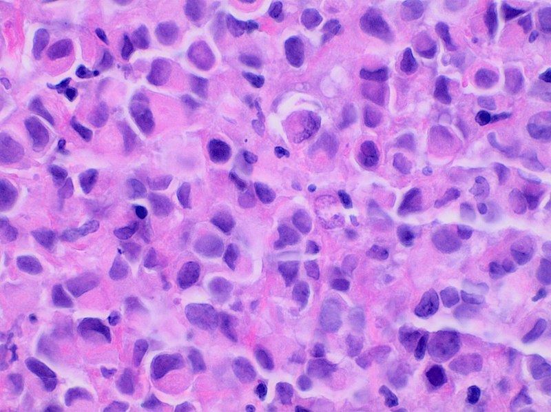 Invasive Lobular Carcinoma