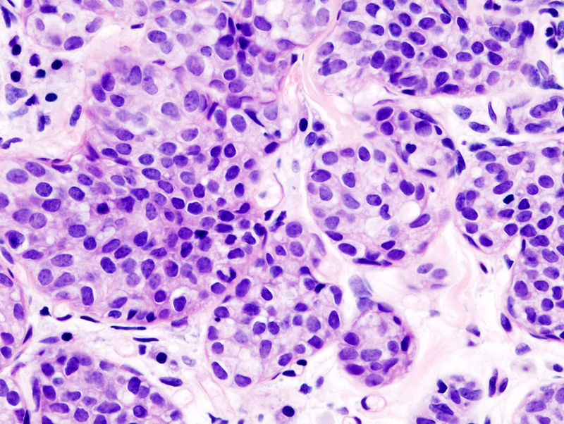 Invasive Lobular Carcinoma