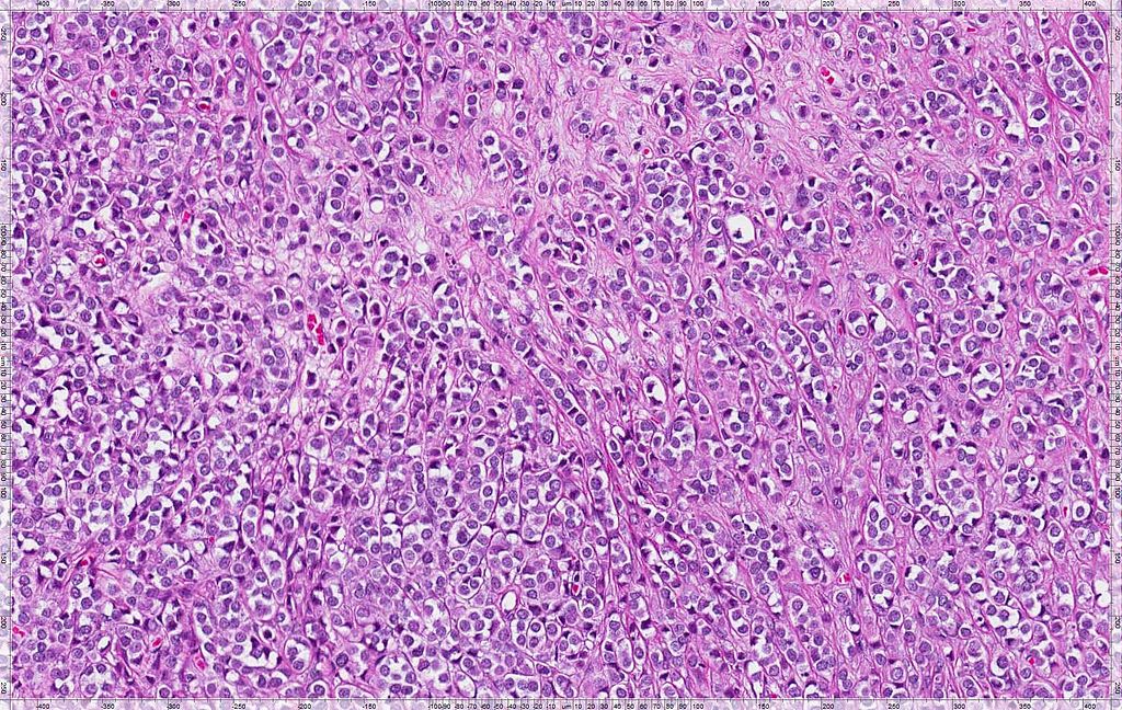 Invasive Lobular Carcinoma