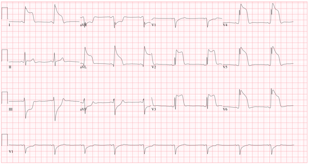 Ischemic Heart Disease