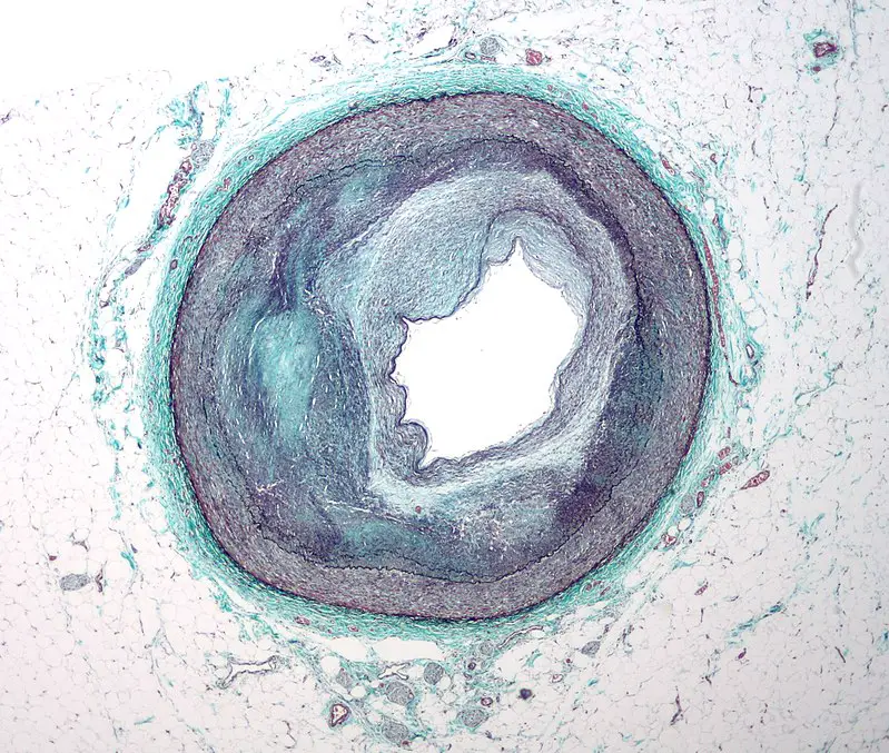 Ischemic Heart Disease