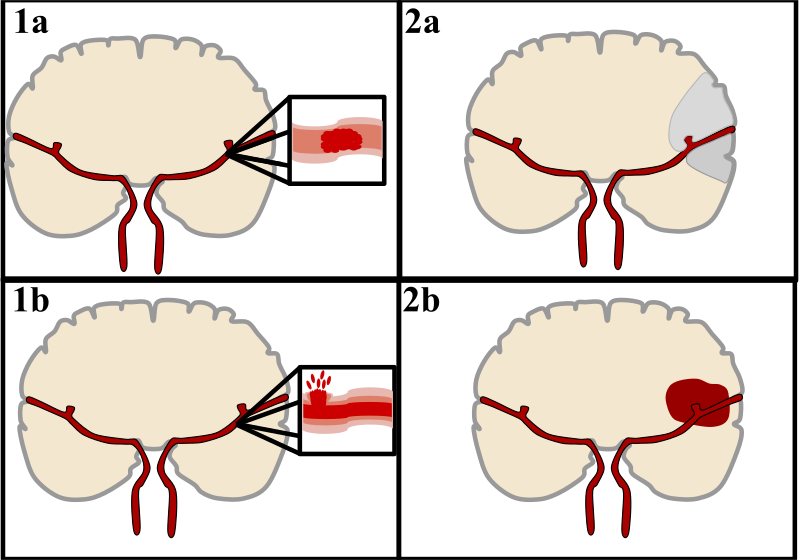 Ischemic Stroke