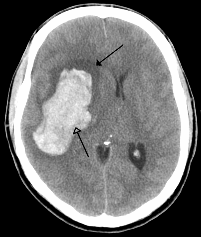 Ischemic Stroke