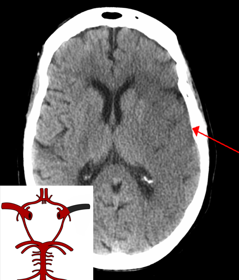 Ischemic Stroke