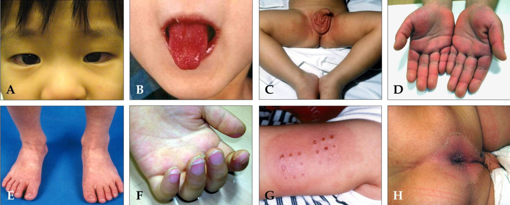 Kawasaki Disease
