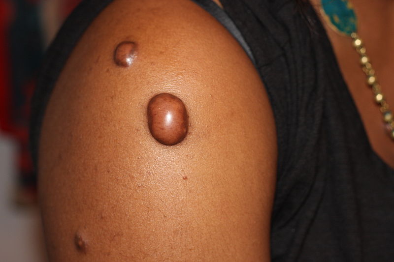 Keloid