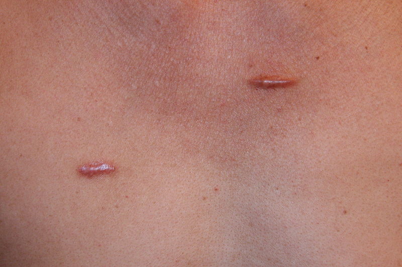 Keloid
