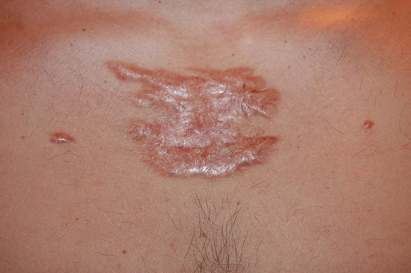 Keloid