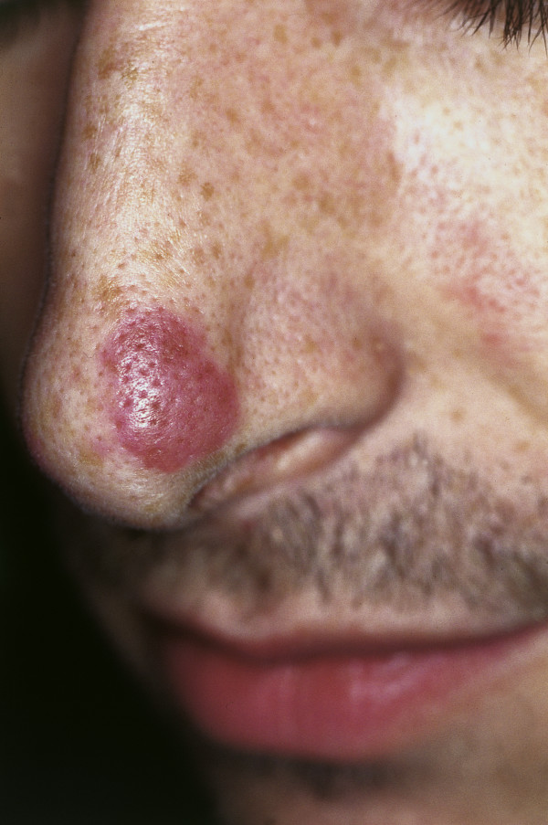 Eosinophilic Granuloma
