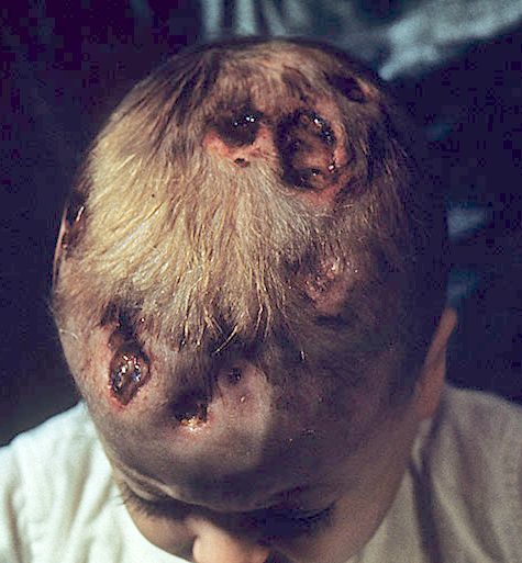 Langerhans Cell Histiocytosis