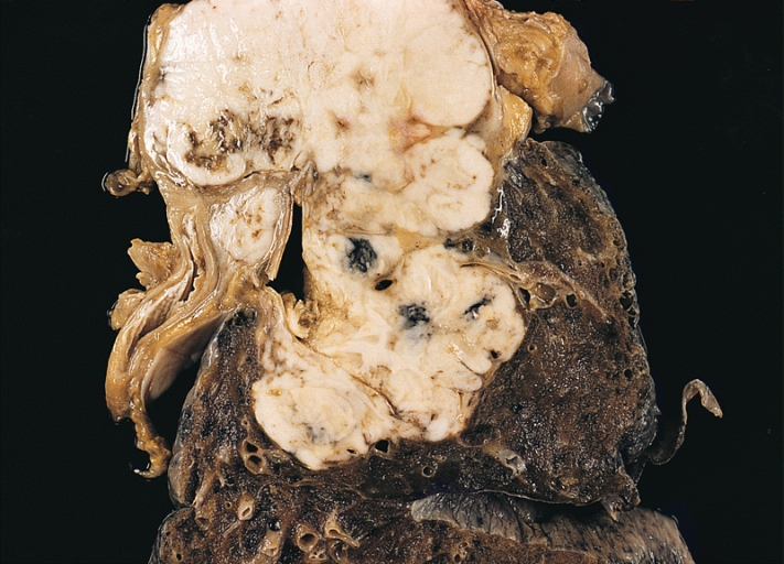 Large Cell Carcinoma of the Lung