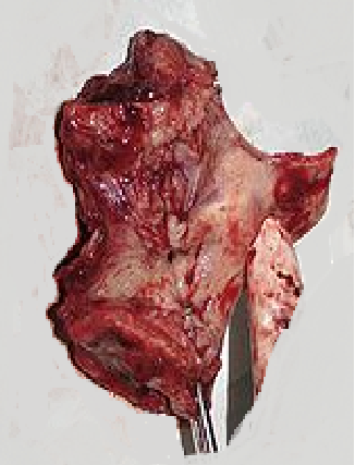 Laryngeal Carcinoma