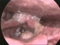 Laryngeal Carcinoma