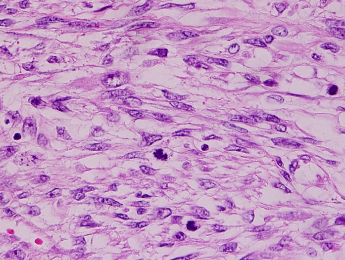 Leiomyosarcoma