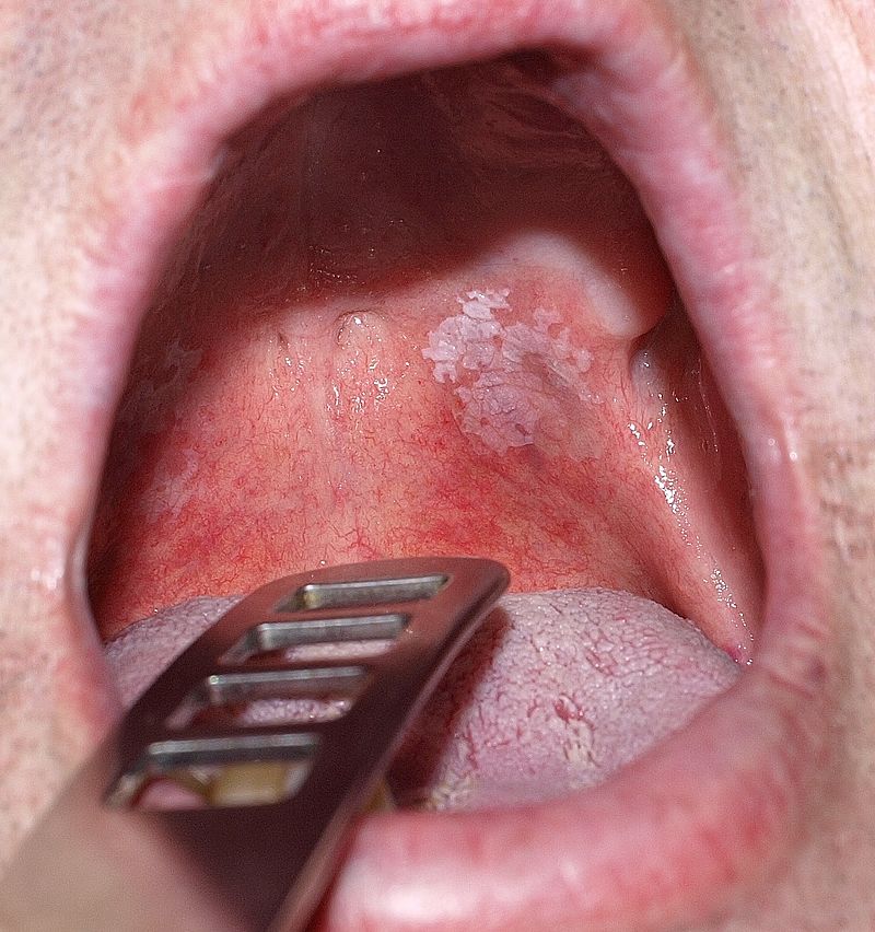 Leukoplakia