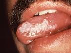 Leukoplakia