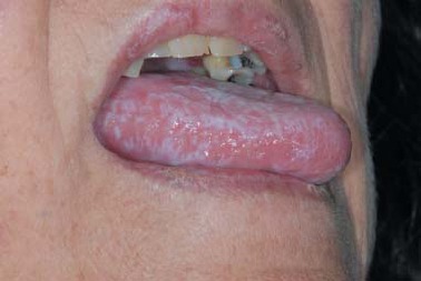 Lichen Planus
