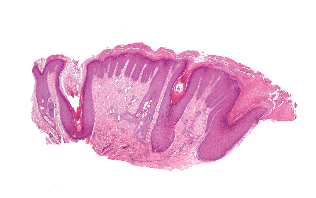 Lichen Simplex Chronicus