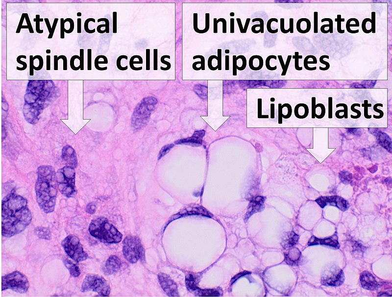 Liposarcoma
