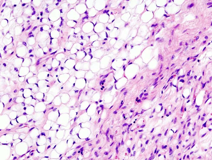 Liposarcoma
