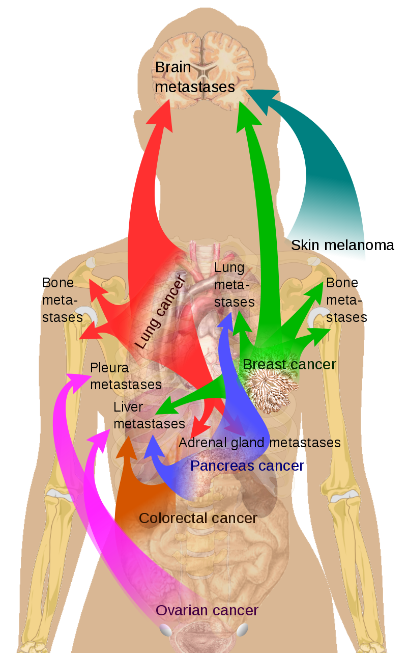 Liver Metastasis