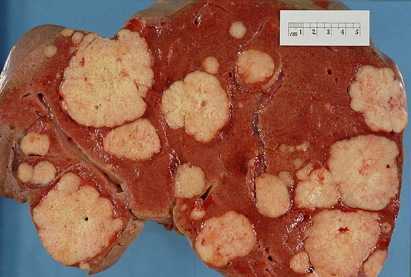 Liver Metastasis