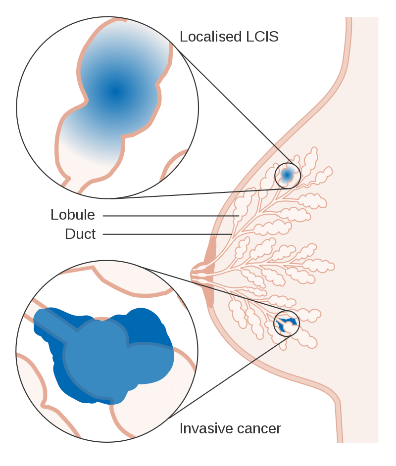 Lobular Carcinoma In Situ (LCIS)