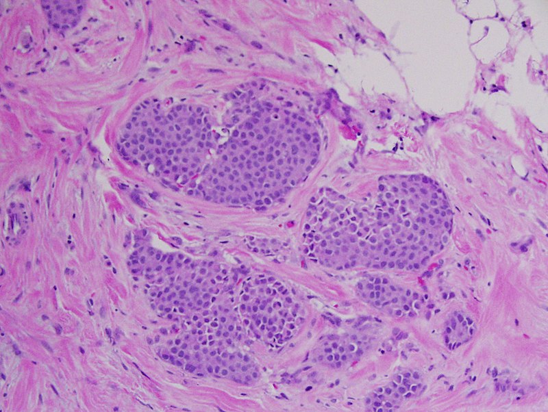 Lobular Carcinoma In Situ (LCIS)