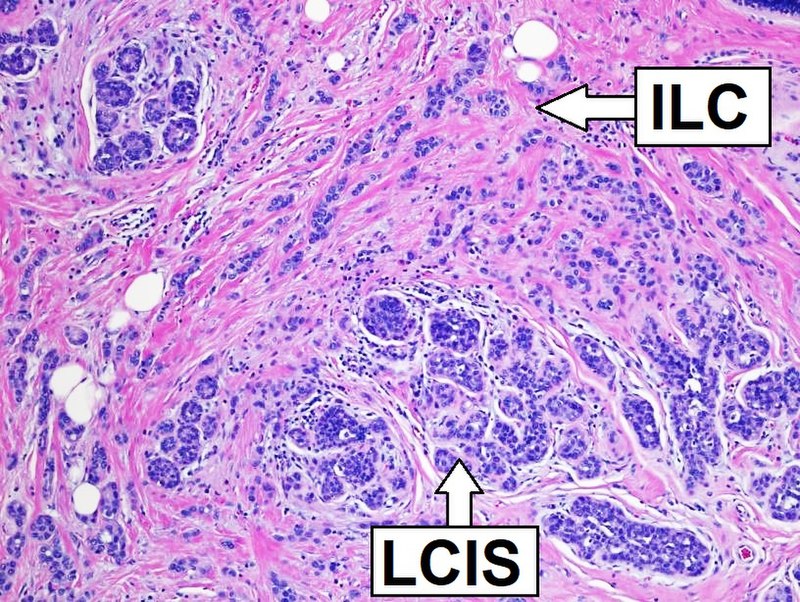Lobular Carcinoma In Situ (LCIS)