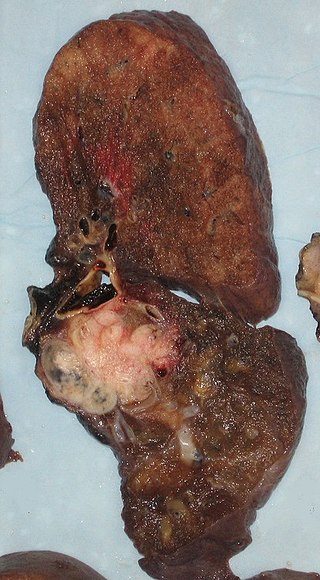 Lung Cancer