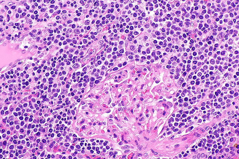 Marginal Zone Lymphoma