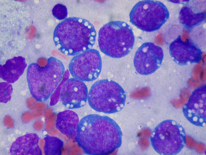 Burkitt Lymphoma