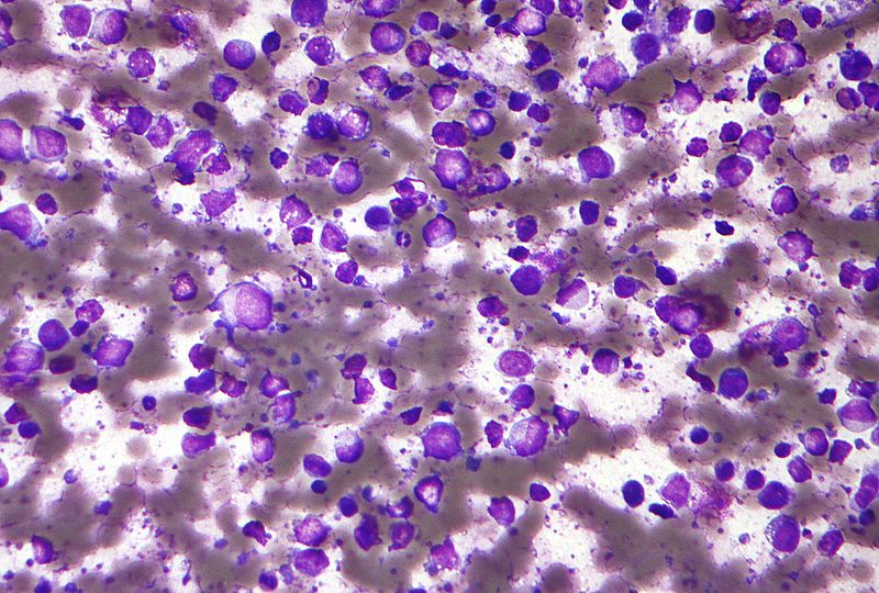 Diffuse Large B-Cell Lymphoma