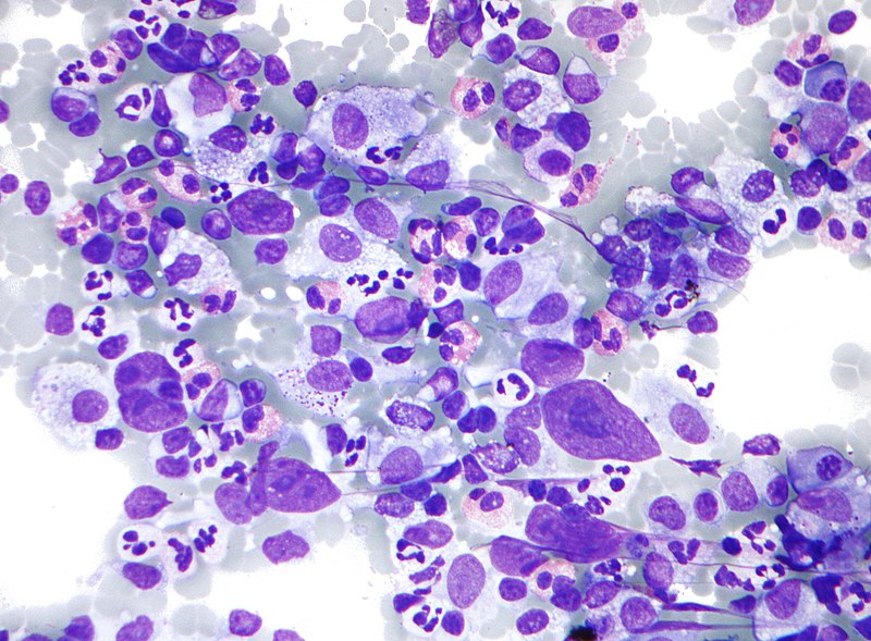Hodgkin Lymphoma