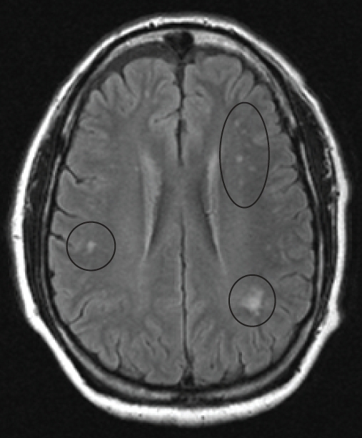 Vitamin B12 Deficiency