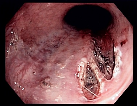 Mallory-Weiss Syndrome