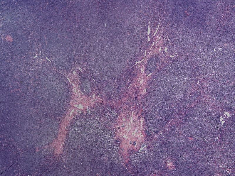 Mantle Cell Lymphoma