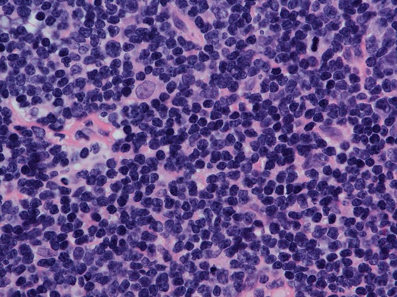 Mantle Cell Lymphoma