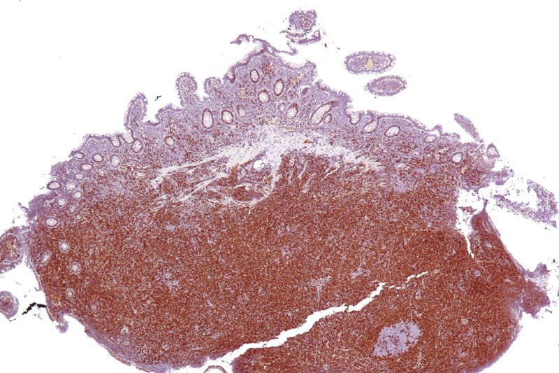 Mantle Cell Lymphoma
