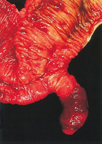 Meckel Diverticulum