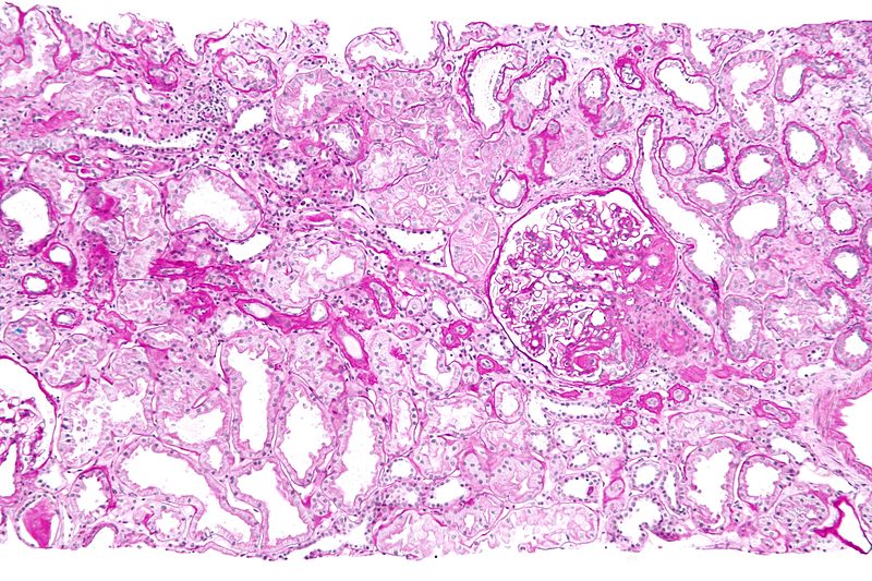 Medullary Cystic Kidney Disease