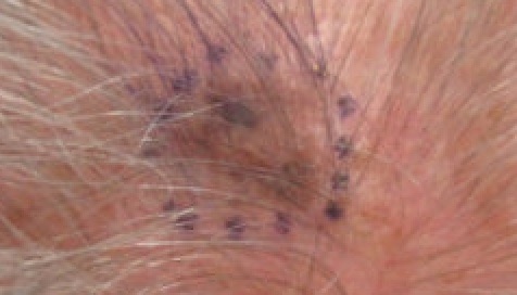 Melanoma