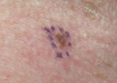 Melanoma