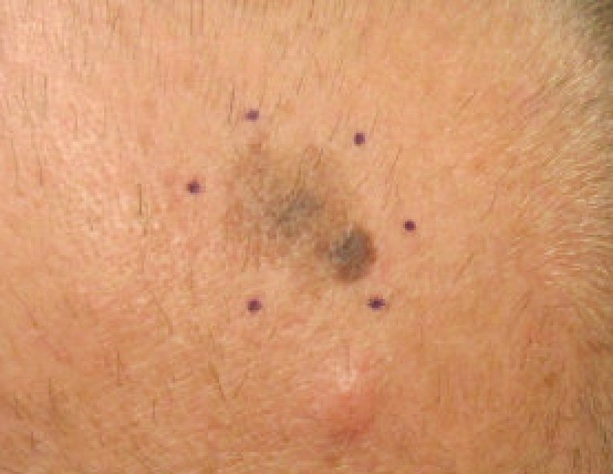 Melanoma
