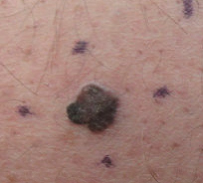Melanoma