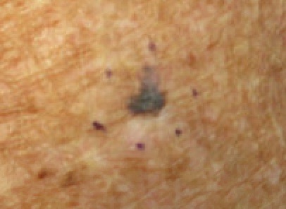 Melanoma