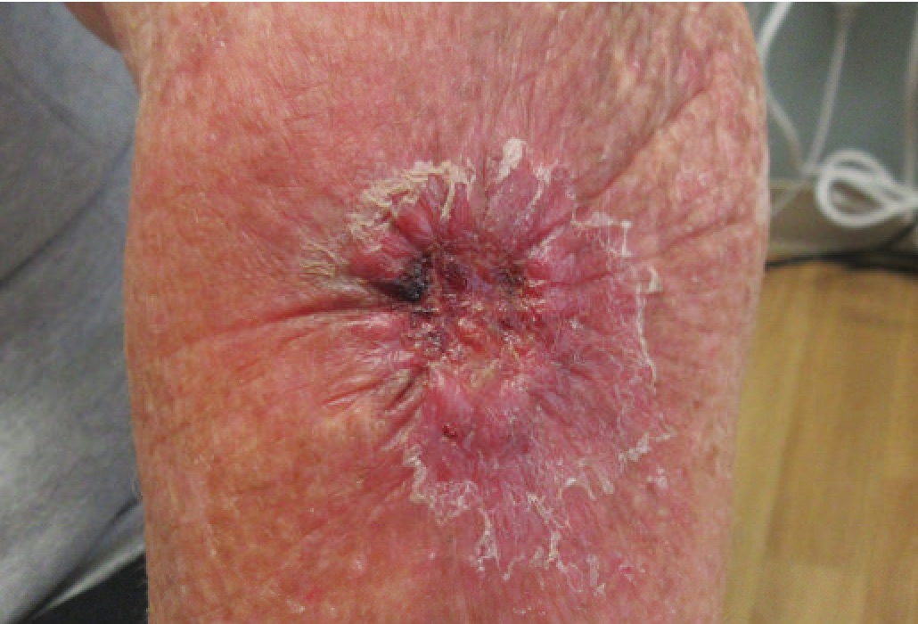 Melanoma