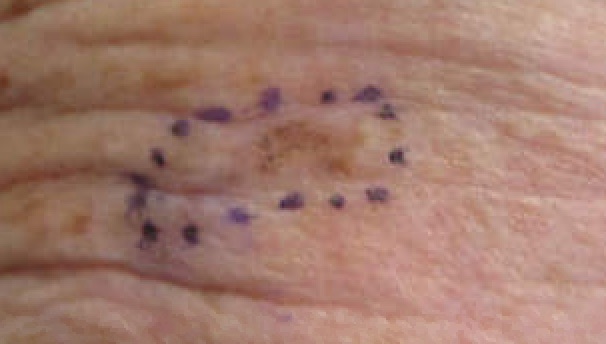 Melanoma