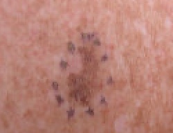 Melanoma