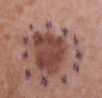 Melanoma